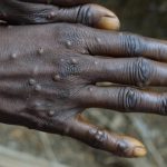 RDC : Plus de 11 000 cas suspects enregistrés des cas de variole du singe